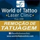 remoção de tatuagem