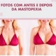 mastopexia com prótese