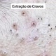 unhas encravadas extração de cravo