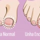 UNHAS ENCRAVADAS
