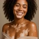 Vitiligo Real